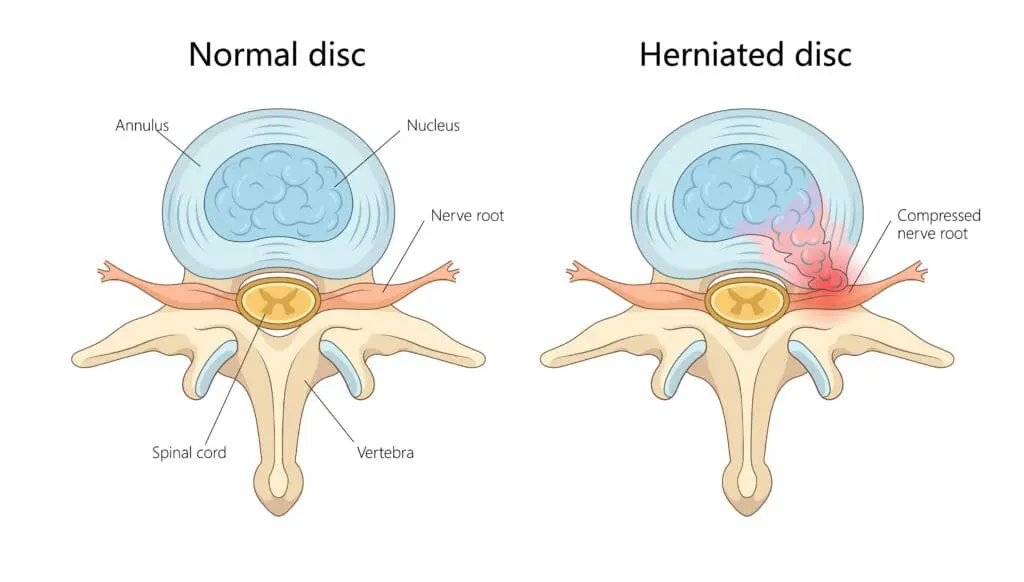 Normal disc vs herniated disk