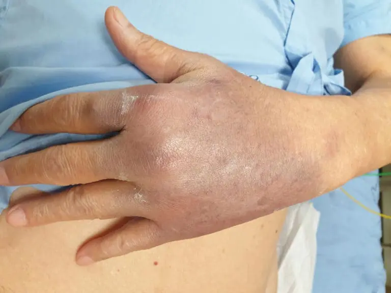 Signs of Internal Bleeding