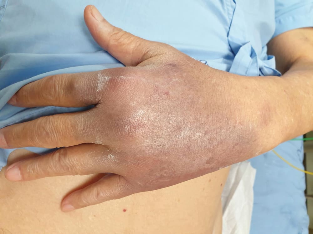 Signs of Internal Bleeding